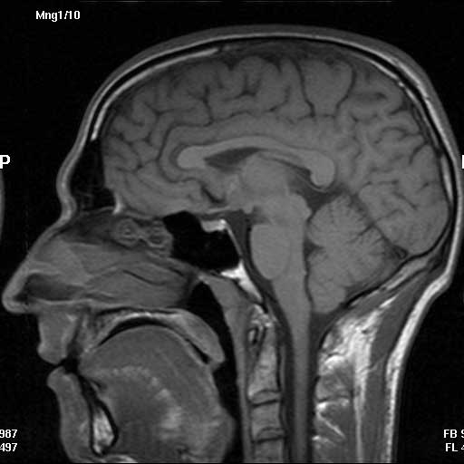 MRI image of Swiss head